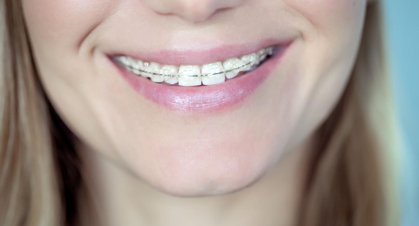Appareil dentaire en céramique : fonctionnement, avantages et indications