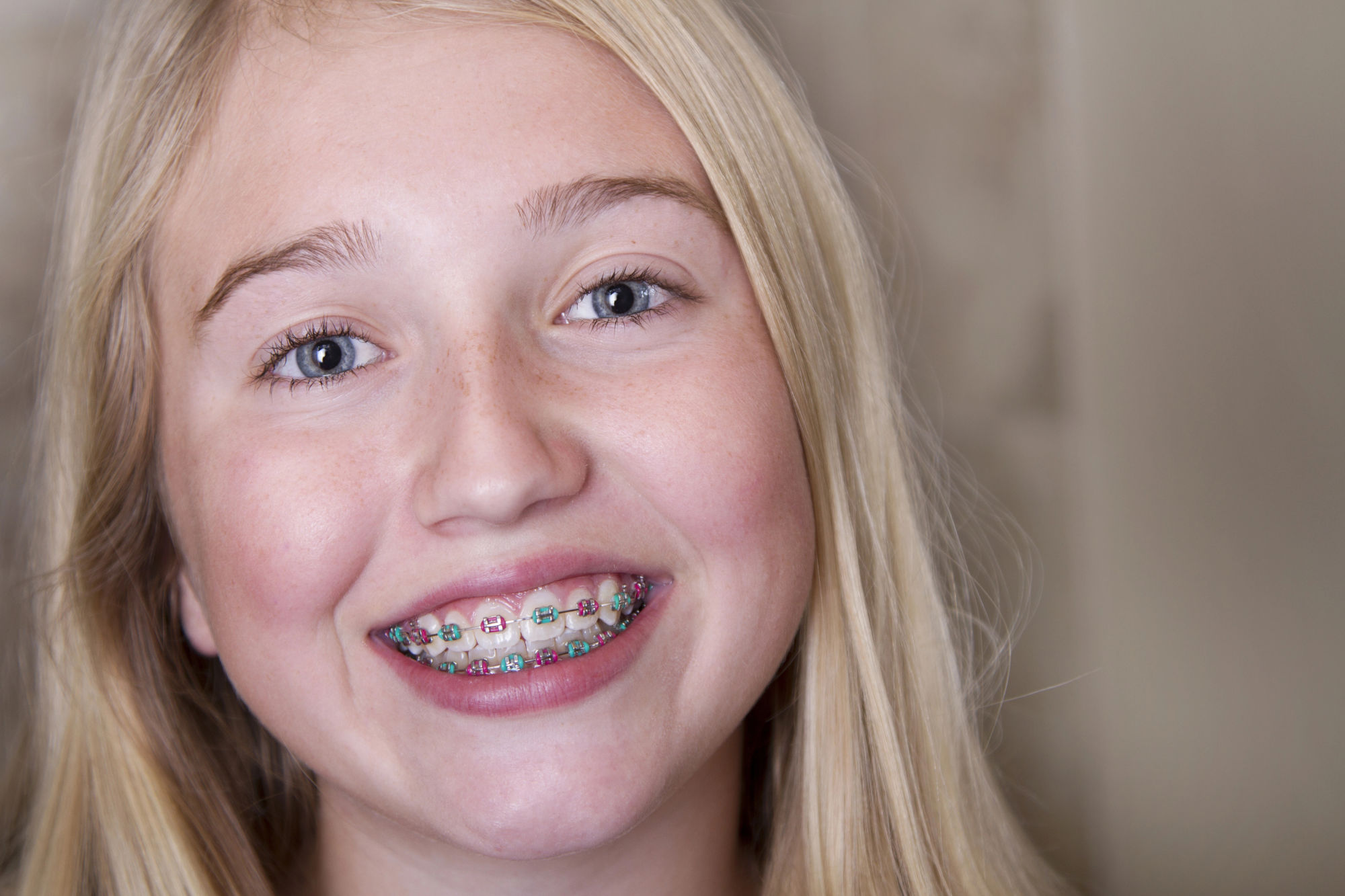 Les bagues restent les appareils orthodontiques les plus utilisés chez les adolescents