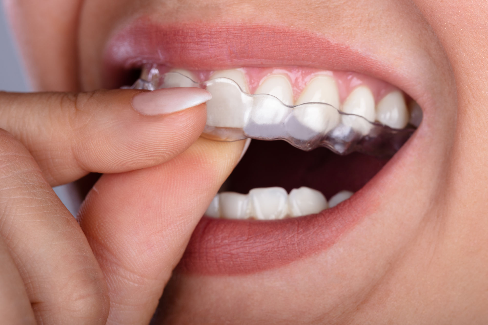 Les aligneurs transparents représentent une alternative de choix pour allier discrétion et performance dans le redressement des dents