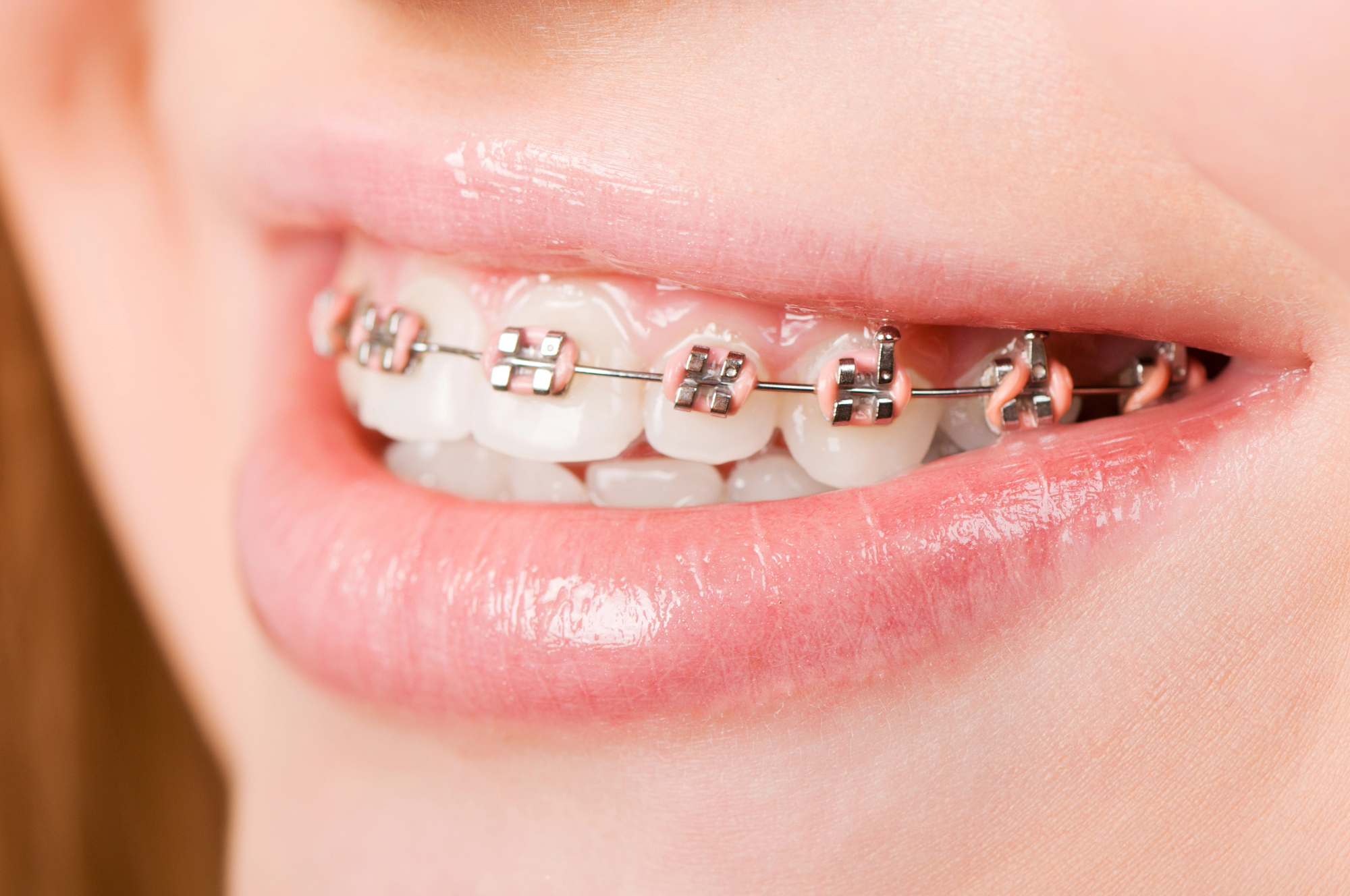 Les appareils dentaires les plus classiques restent les bagues en métal