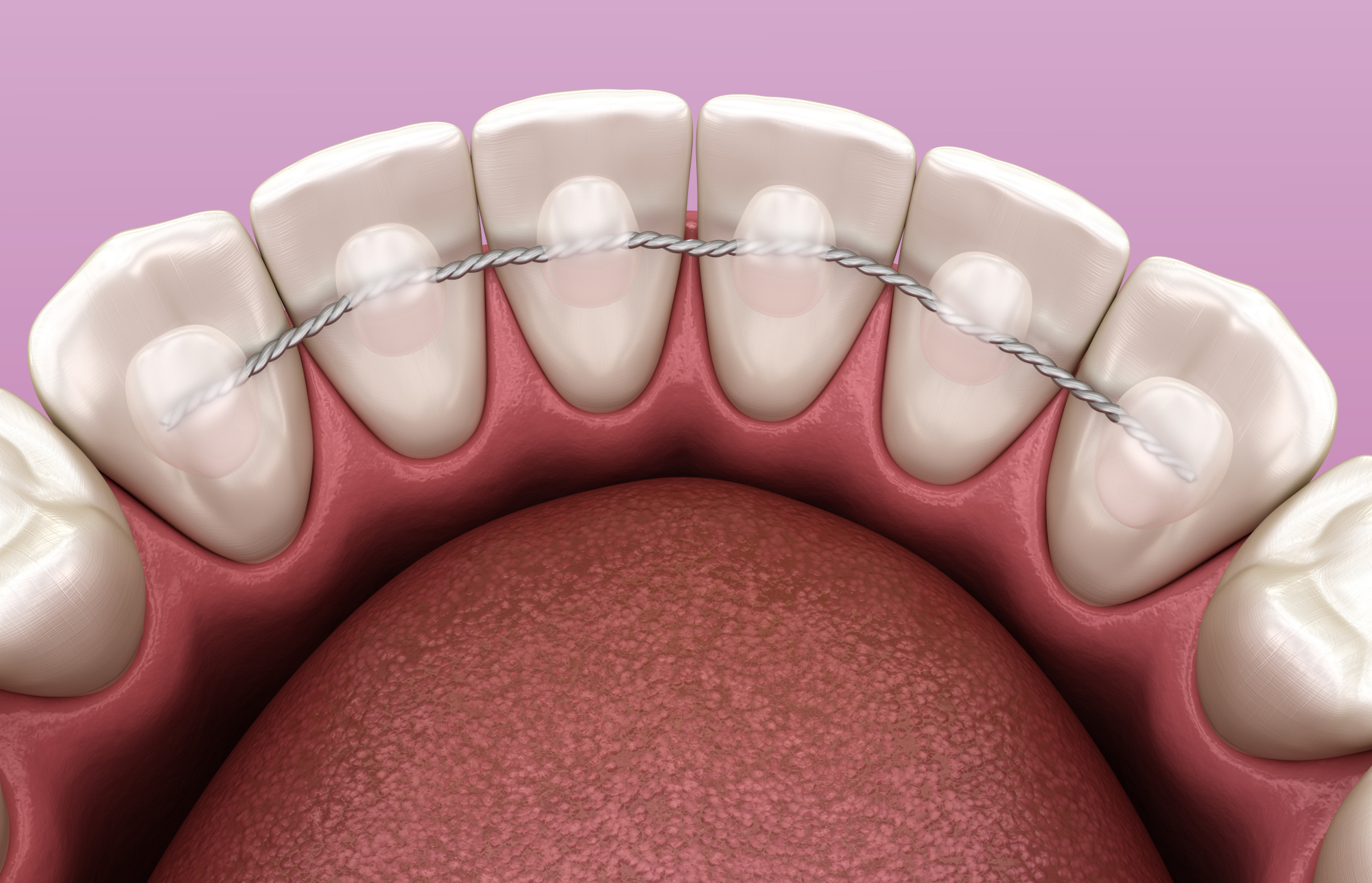 Le dispositif de contention fixe le plus courant est un fin fil métallique collé sur la face linguale des dents antérieures
