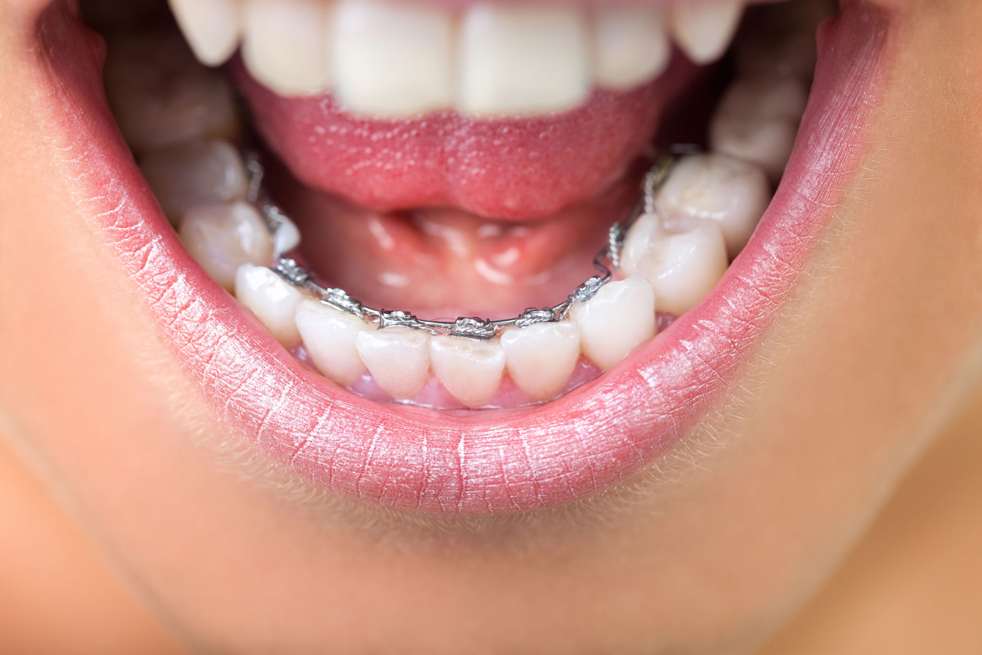  Contrairement aux bagues classiques positionnées sur la face visible des dents, l'appareil lingual se fixe sur leur face interne, côté langue. Ainsi, il reste totalement invisible pour votre entourage, vous permettant de suivre votre traitement orthodontique en préservant votre image et votre sourire.