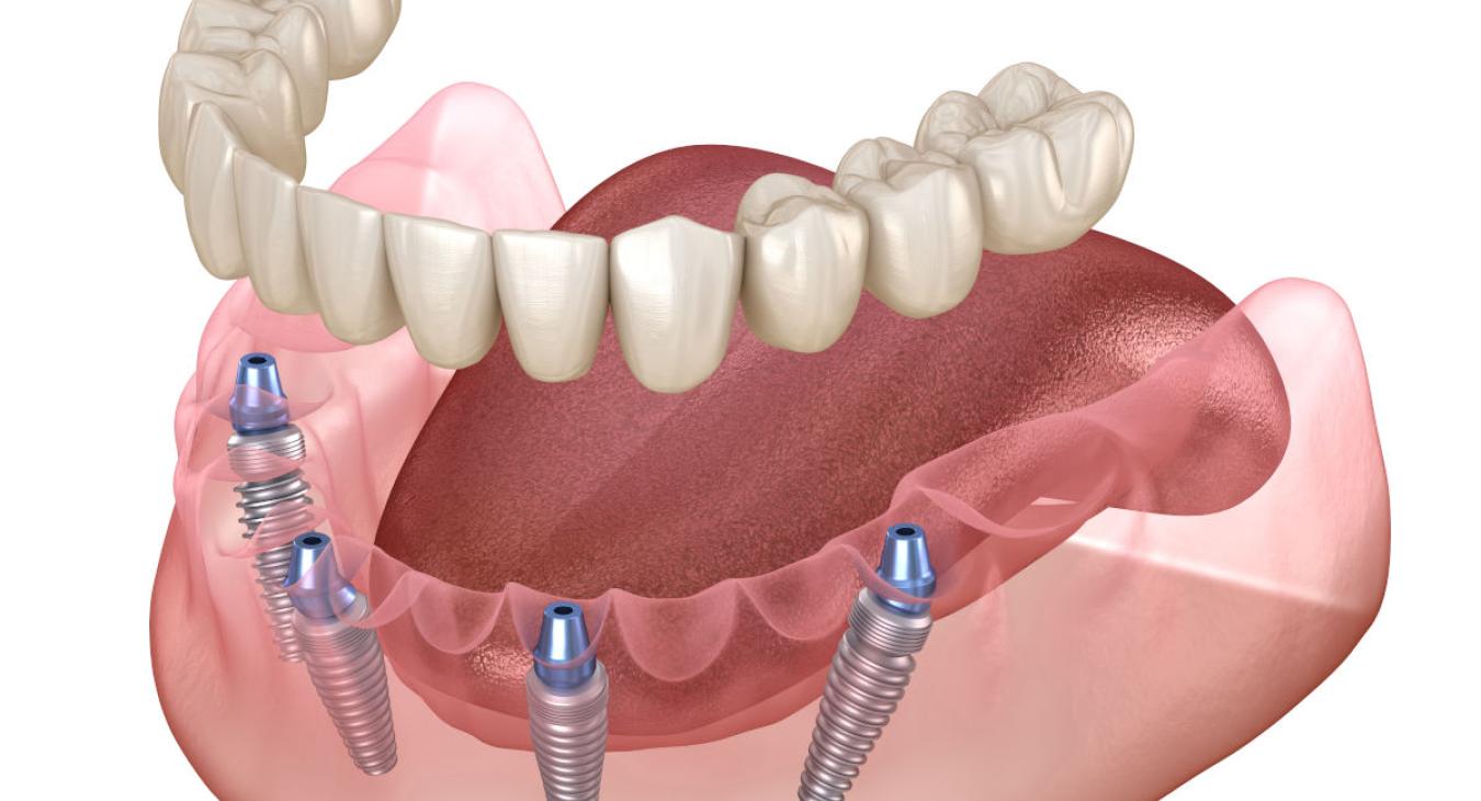 l’implant dentaire révolutionnaire !