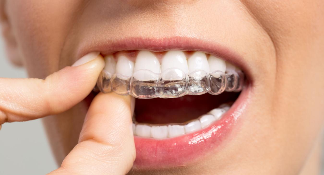 Confiance retrouvée : les nouveaux appareils dentaires invisibles