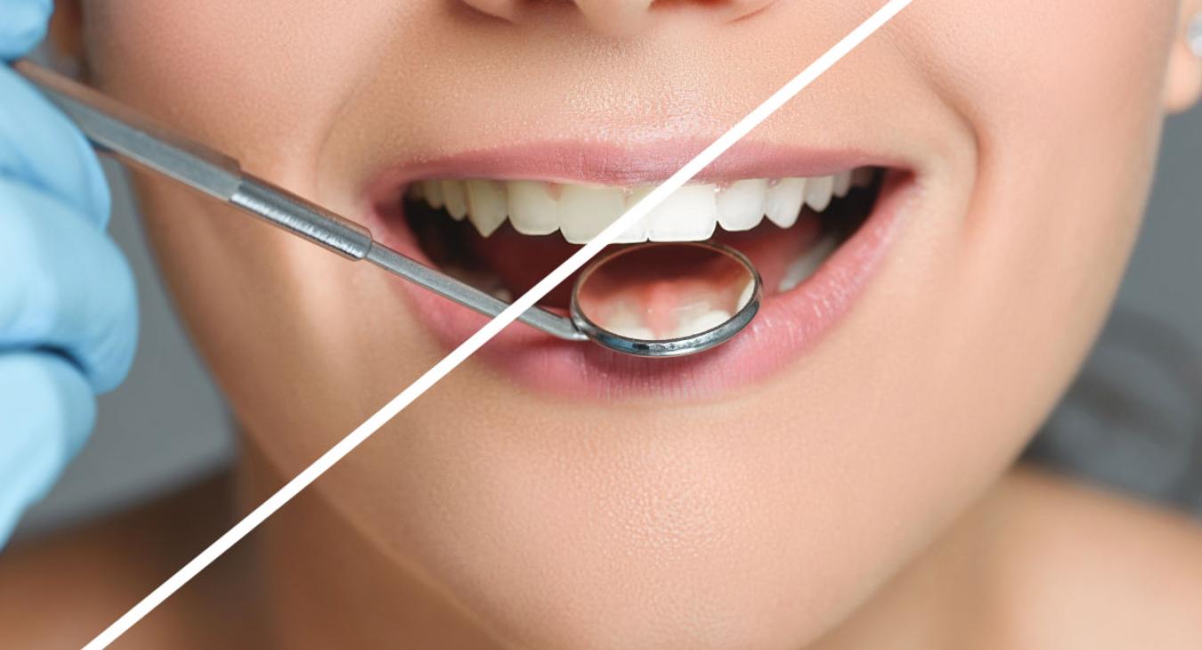 Blanchiment dentaire chez le dentiste : indication, procédure et tarif