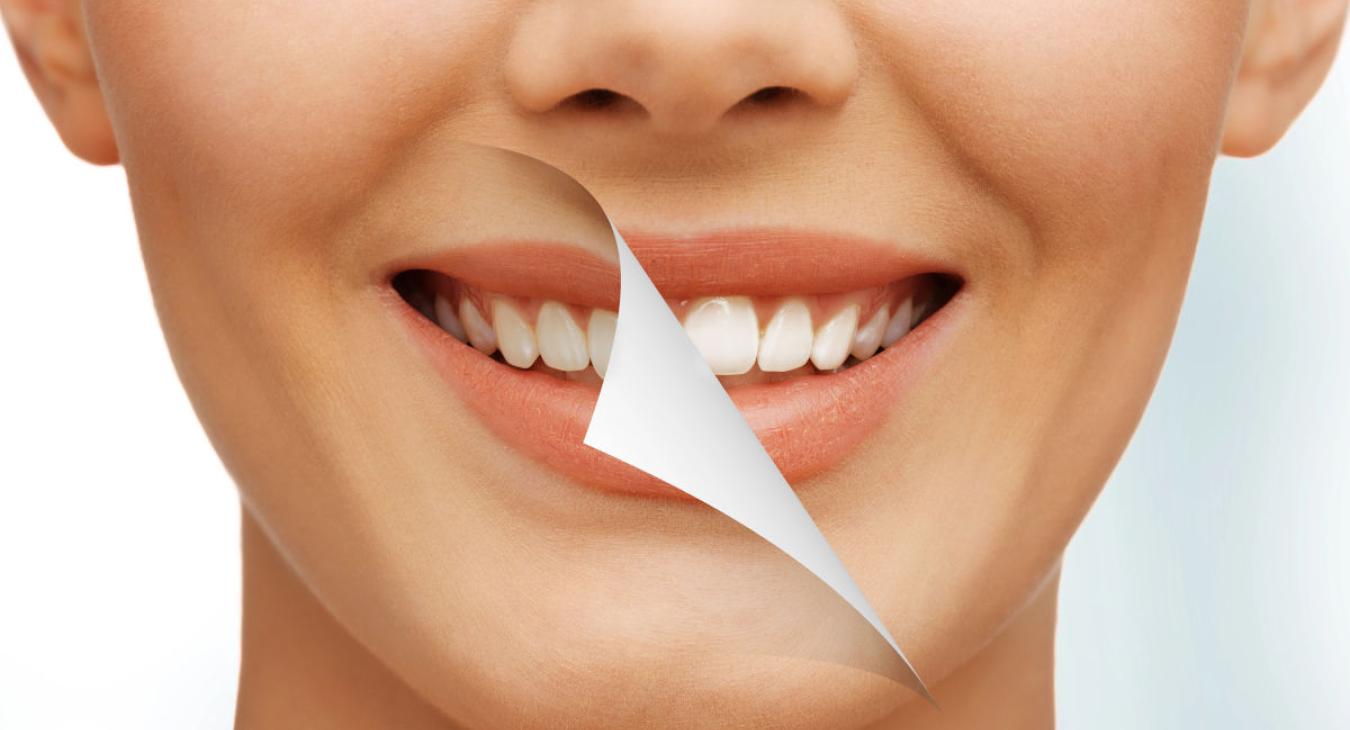 Blanchiment dentaire : comment avoir les dents blanches ?
