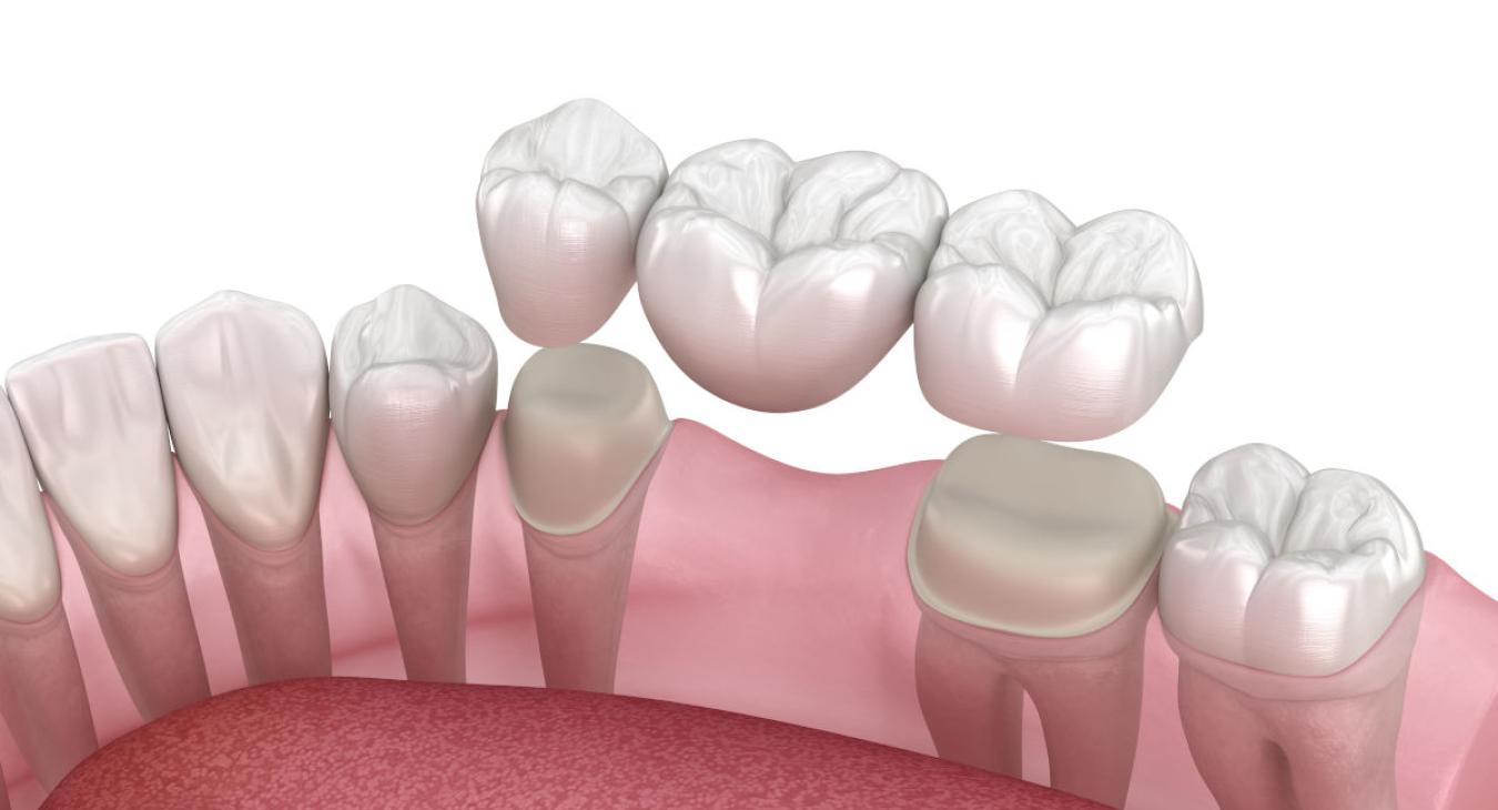 Bridge dentaire : le guide complet sur cette prothèse dentaire fixe