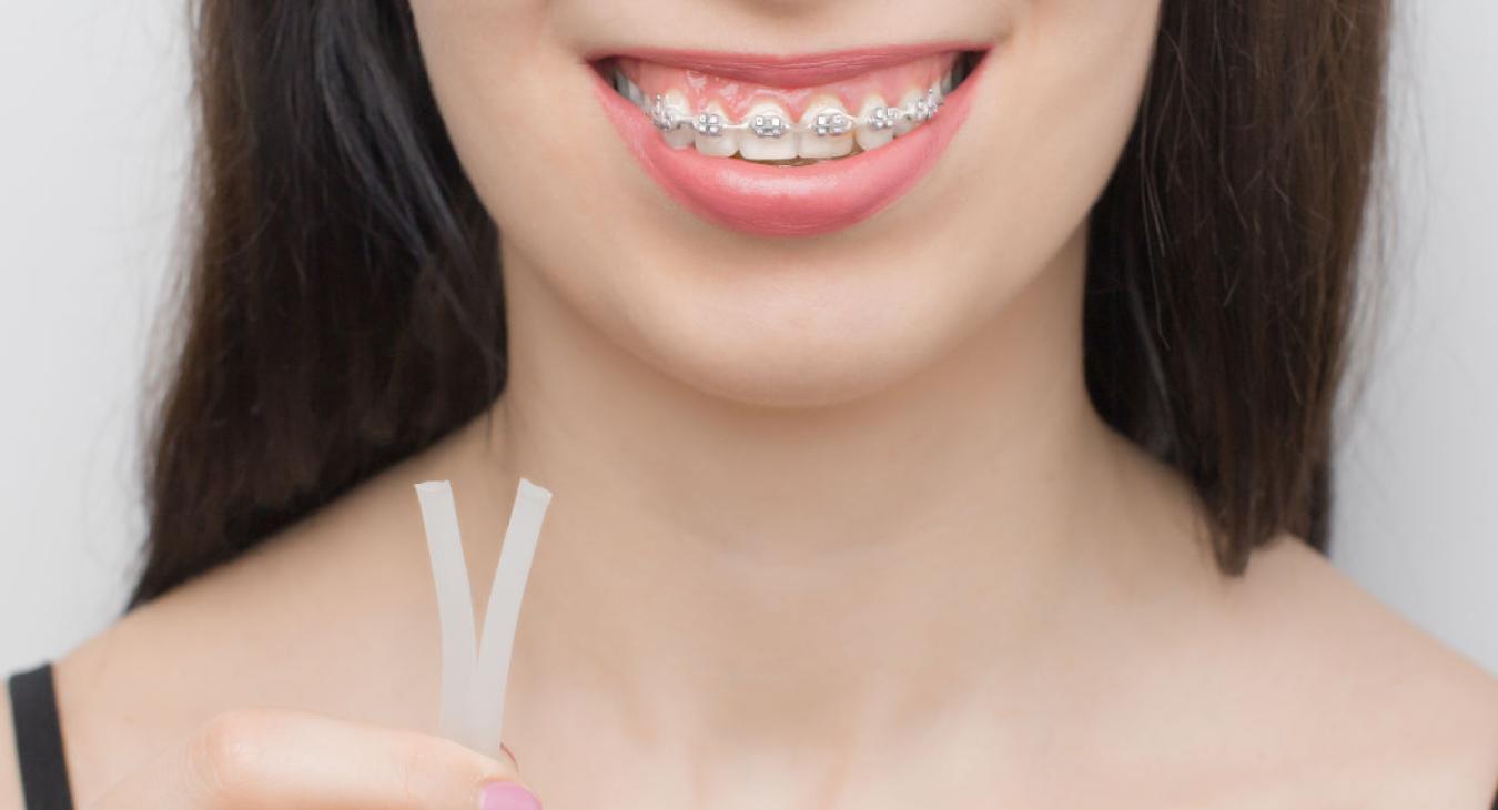 Cire orthodontique : conseils pour la choisir et l’utiliser correctement