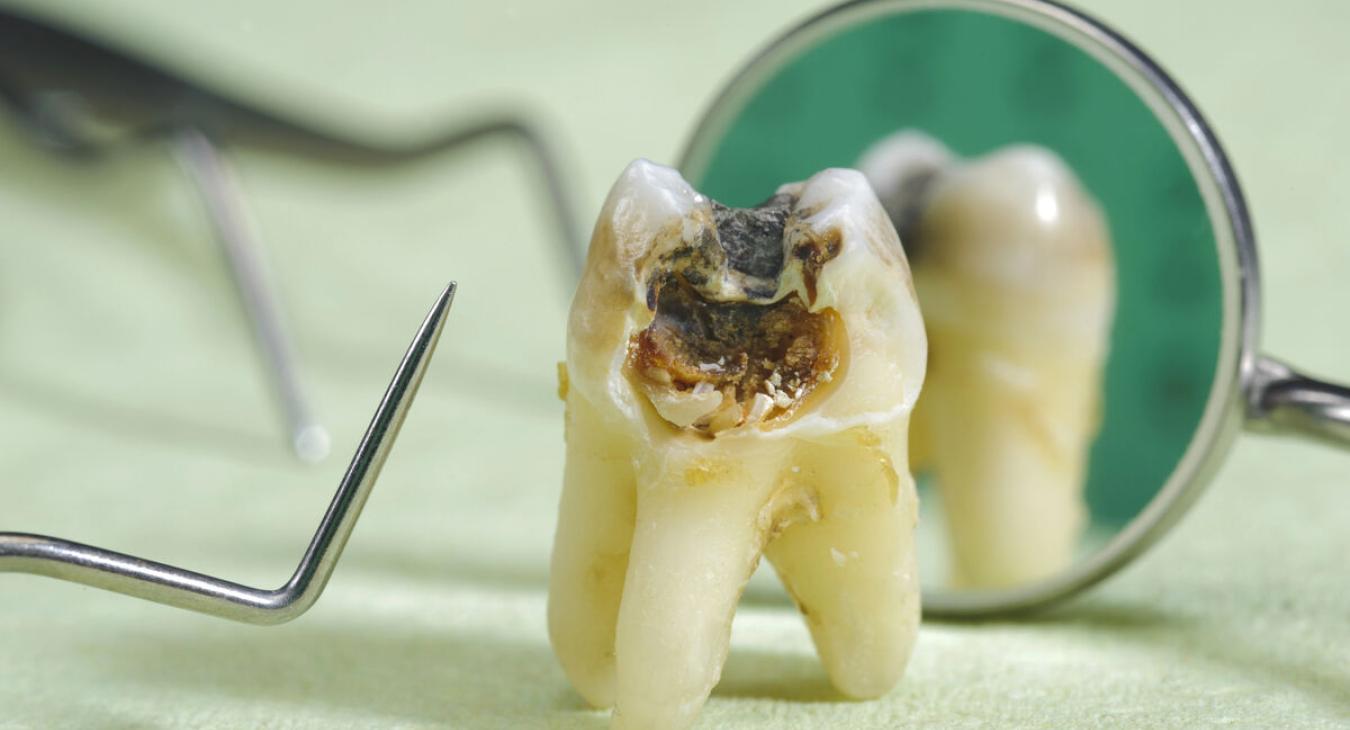 Tout savoir sur les caries dentaires