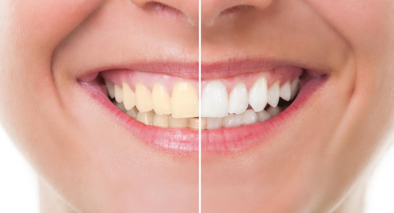 Dents jaunes : les causes principales et les meilleures solutions