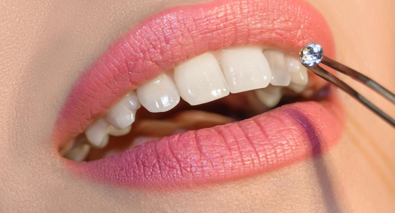 Grillz et strass dentaires : tout savoir sur la mode des bijoux de dents