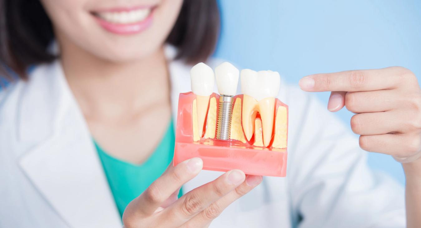L’implant dentaire : tout savoir pour une prise de décision éclairée