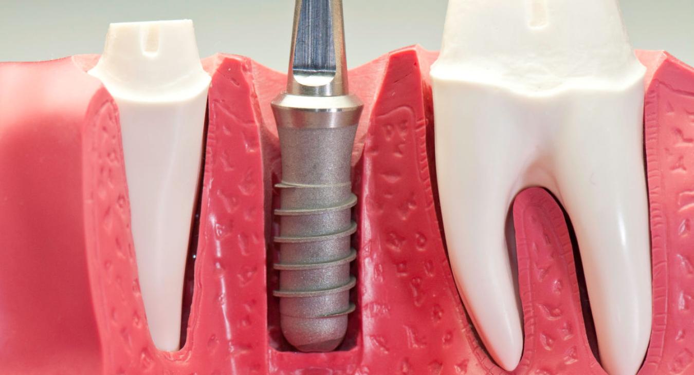 Implants dentaires moins chers : les solutions pour économiser