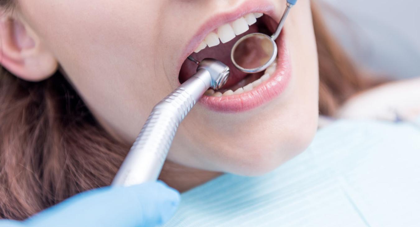 Limer les dents : tout savoir sur le stripping dentaire