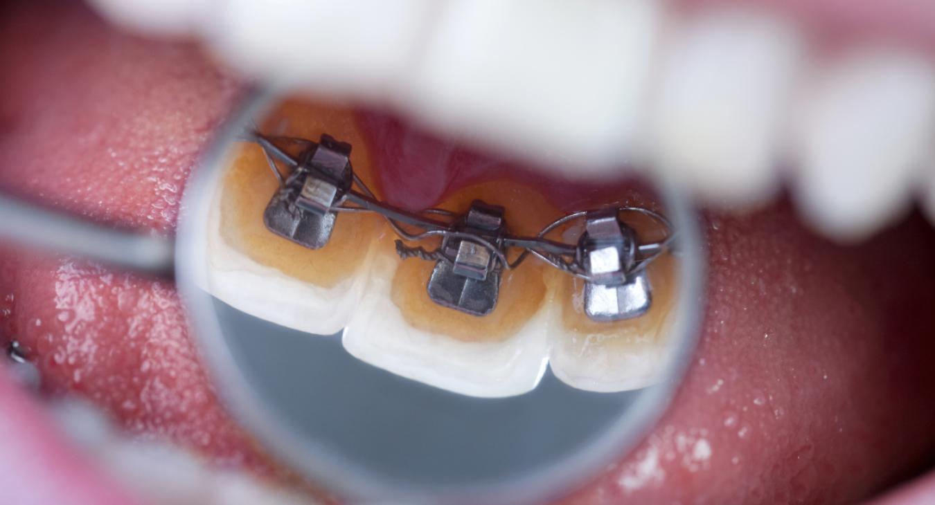Orthodontie Linguale