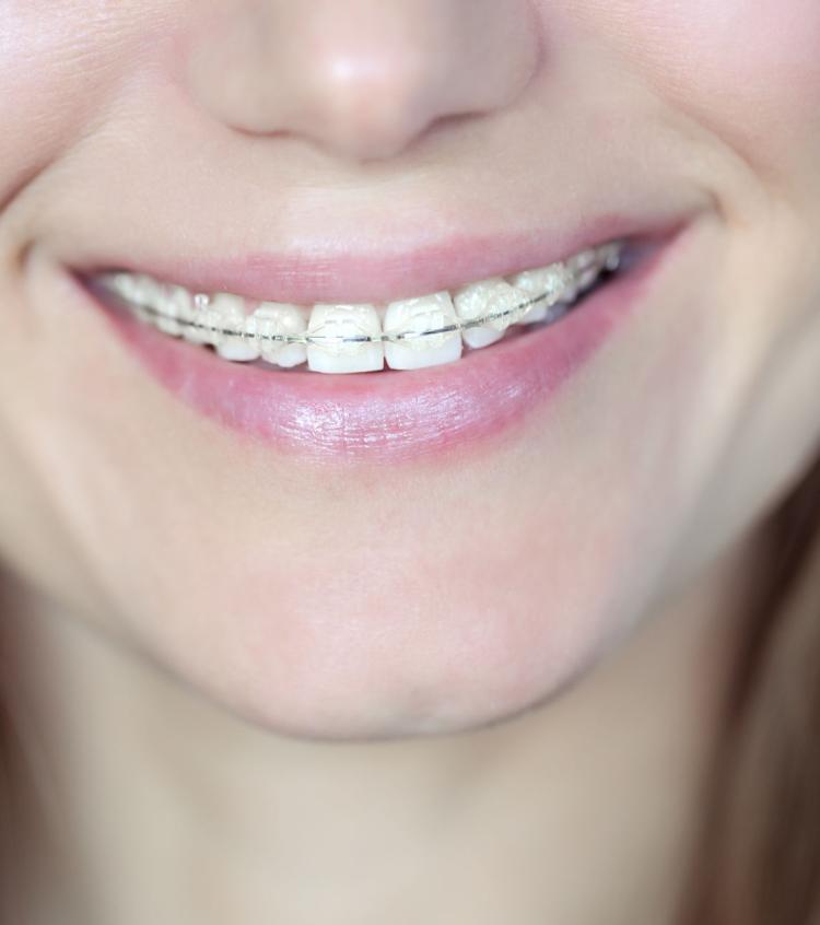Appareil dentaire en céramique : fonctionnement, avantages et indications